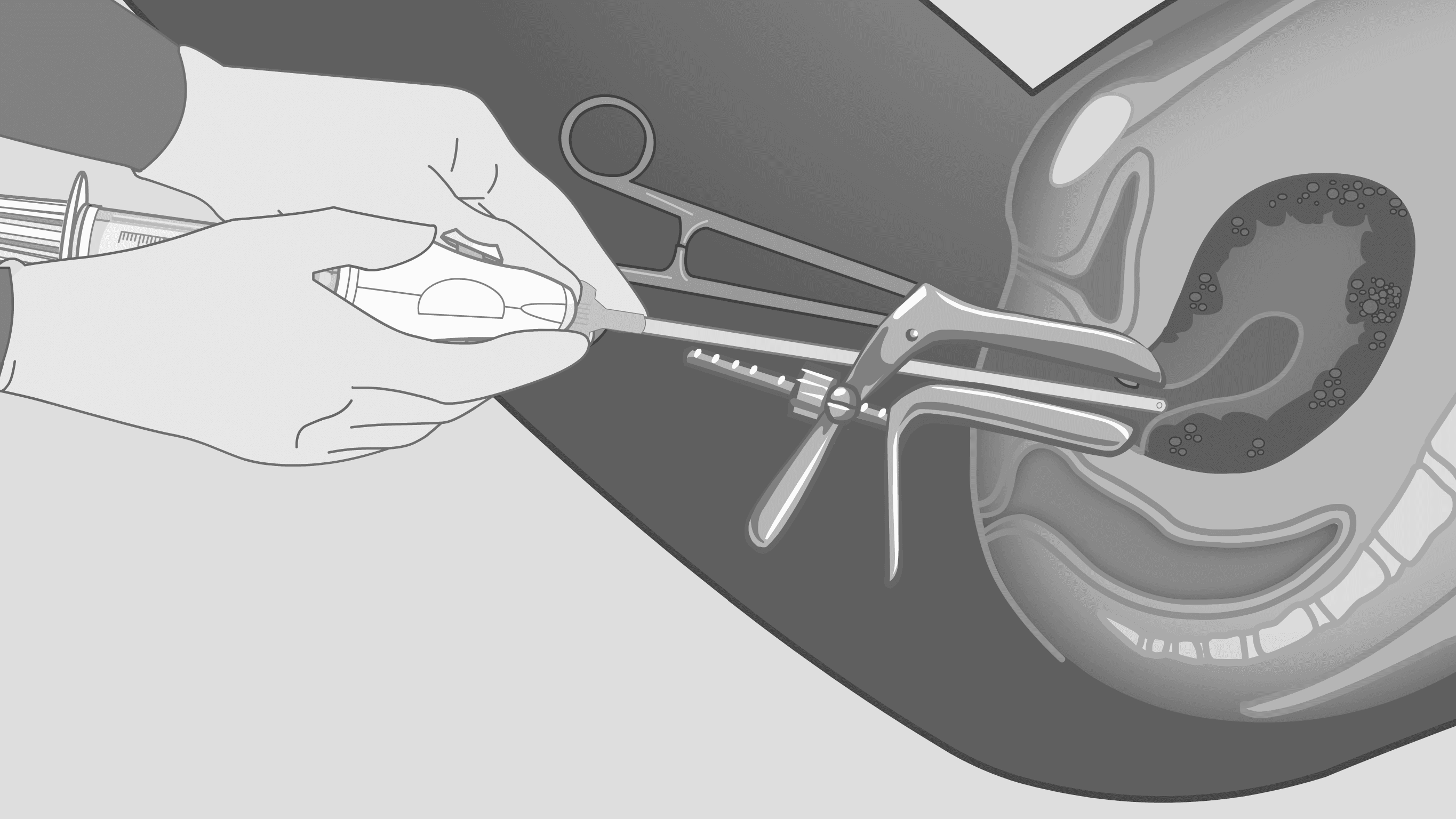Европын Холбооны нийгмийн санг ашиглан гишүүн орны эмэгтэйчүүдэд "аюулгүй үр" хөндөлтийн үйлчилгээ үзүүлэх боломжтой